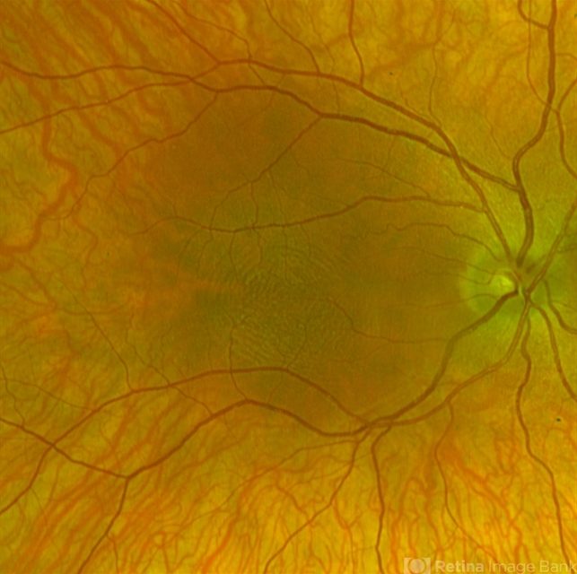 Foveal Hypoplasia: Hereditary ocular lesion
