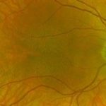 Foveal Hypoplasia