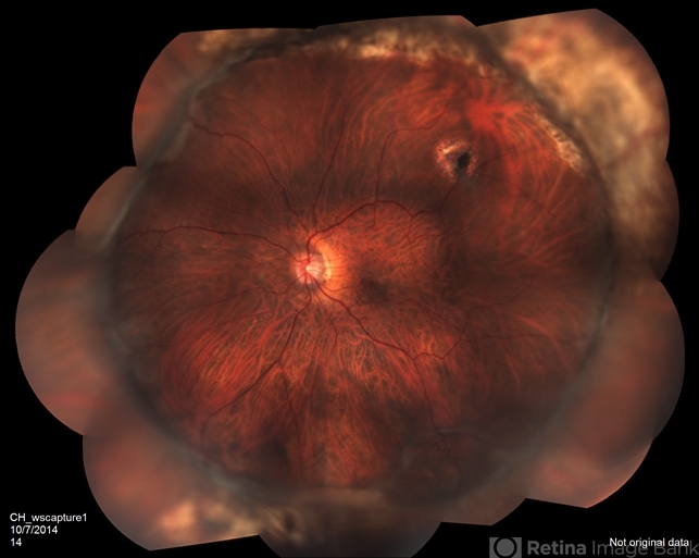 Proliferative Vitreoretinopathy