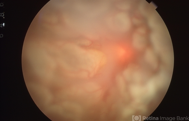 Proliferative Vitreoretinopathy