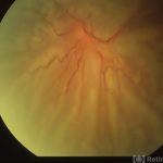 Proliferative Vitreoretinopathy