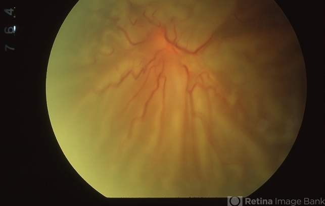 Proliferative Vitreoretinopathy (PVR): A Full Review - Ophthalmology ...