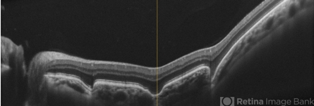 Focal Choroidal Excavation