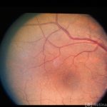 Diffuse Unilateral Subacute Neuroretinitis