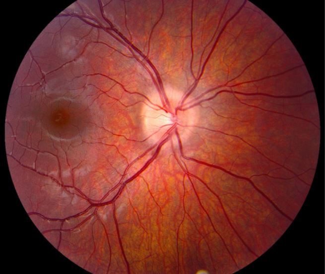 Myelin Oligodendrocyte Glycoprotein (MOG)-IgG Associated Optic Neuritis