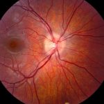 Myelin Oligodendrocyte Glycoprotein (MOG)-IgG Associated Optic Neuritis