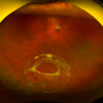 Dislocated Intraocular Lens