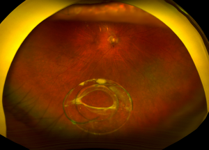 Dislocated Intraocular Lens (IOL): case study, entity and diagnosis