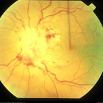 Waldenstrom Macroglobulinemia and Hyperviscosity-related Retinopathy
