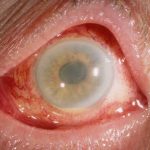 Toxic Anterior Segment Syndrome