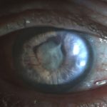 Neovascular Glaucoma
