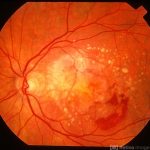 Age-Related Macular Degeneration