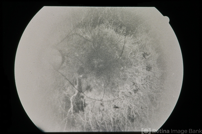 Retinitis pigmentosa