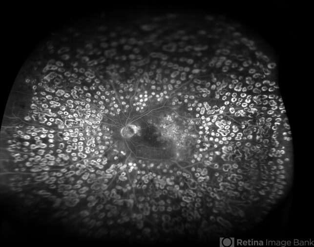 Diabetic Retinopathy