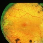 Retinitis pigmentosa