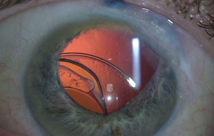 Dislocated Intraocular Lens