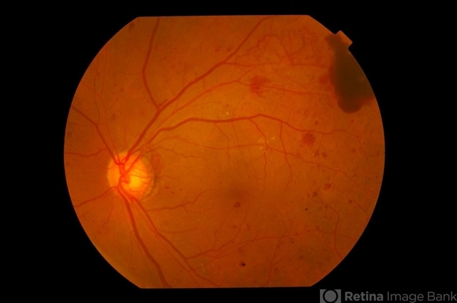 Diabetic Retinopathy