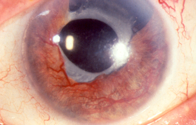 Neovascular Glaucoma
