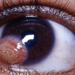 Corneal Dermoid