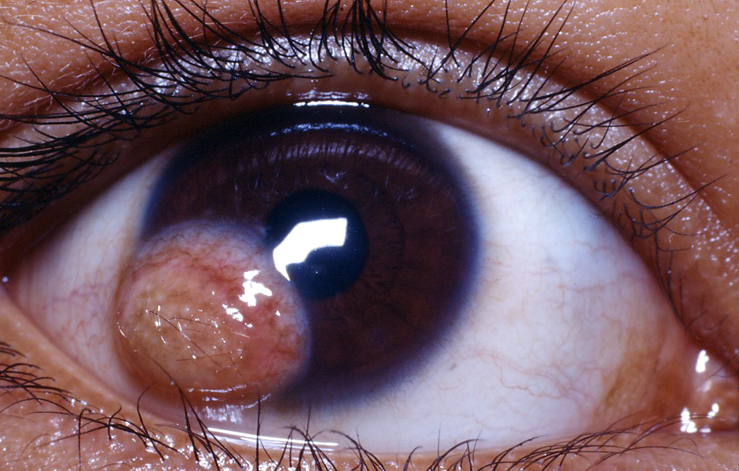 Corneal Dermoid Full Article Ophthalmology Education