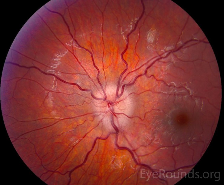 Myelin Oligodendrocyte Glycoprotein (MOG)-IgG Associated Optic Neuritis