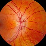 Leber Hereditary Optic Neuropathy