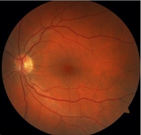 Myelin Oligodendrocyte Glycoprotein (MOG)-IgG Associated Optic Neuritis