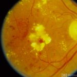 Diabetic Retinopathy