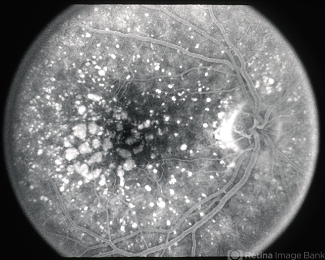 Age-Related Macular Degeneration