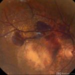 Age-Related Macular Degeneration