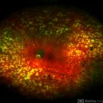 Diabetic Retinopathy