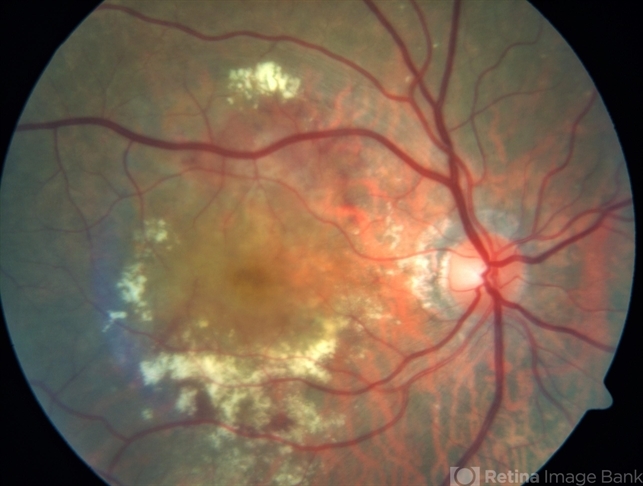 Age-Related Macular Degeneration