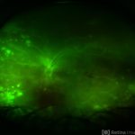 Acute Retinal Necrosis