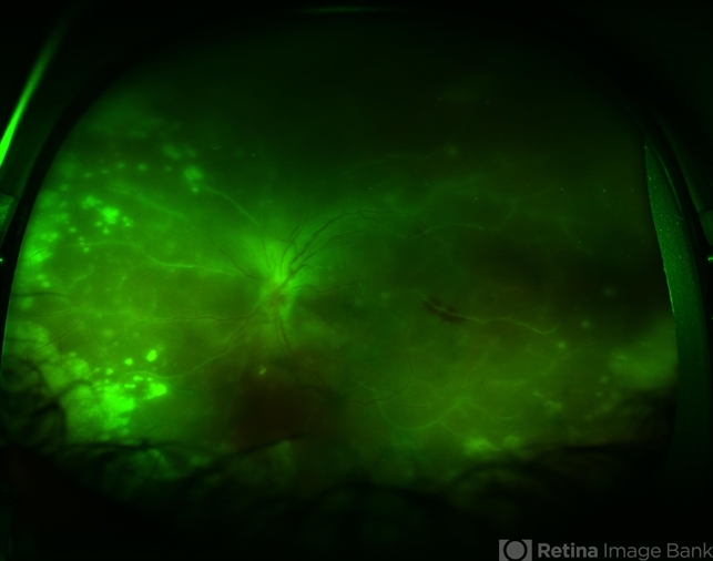 Acute Retinal Necrosis Arn Ophthalmology Education