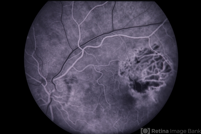 Presumed ocular histoplasmosis syndrome