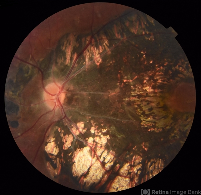 Pigmented Paravenous Retinochoroidal Atrophy