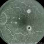 Presumed ocular histoplasmosis syndrome
