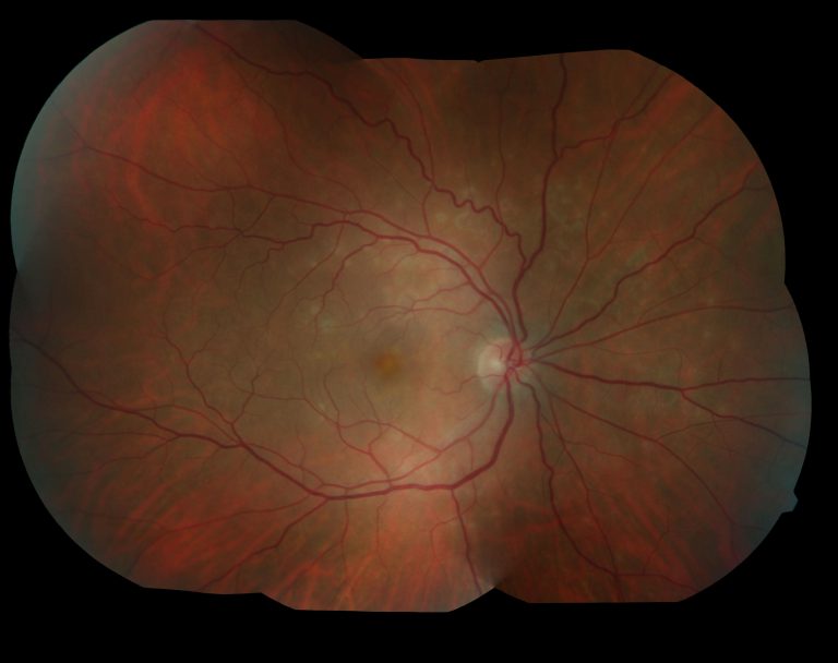 Multiple Evanescent White Dot Syndrome (MEWDS)