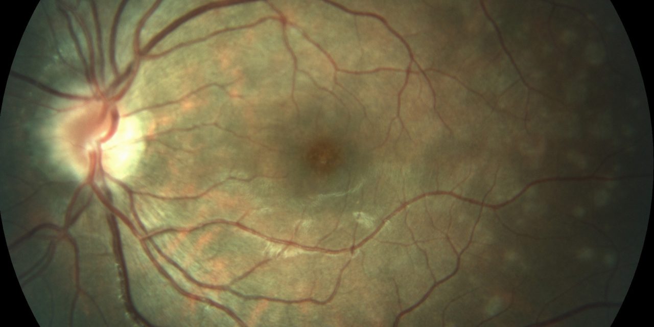 Multiple Evanescent White Dot Syndrome (MEWDS)