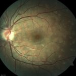 Multiple Evanescent White Dot Syndrome (MEWDS)