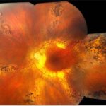 Pigmented Paravenous Retinochoroidal Atrophy