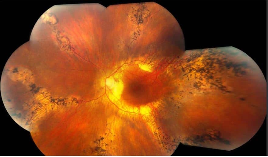 Pigmented Paravenous Retinochoroidal Atrophy (PPRCA)