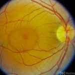 Central Serous Chorioretinopathy