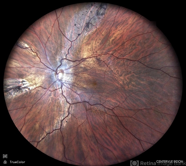 Pigmented Paravenous Retinochoroidal Atrophy
