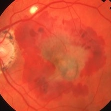 Presumed Ocular Histoplasmosis Syndrome