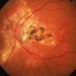 Presumed Ocular Histoplasmosis Syndrome