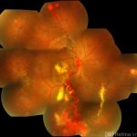 Von Hippel-Lindau Syndrome