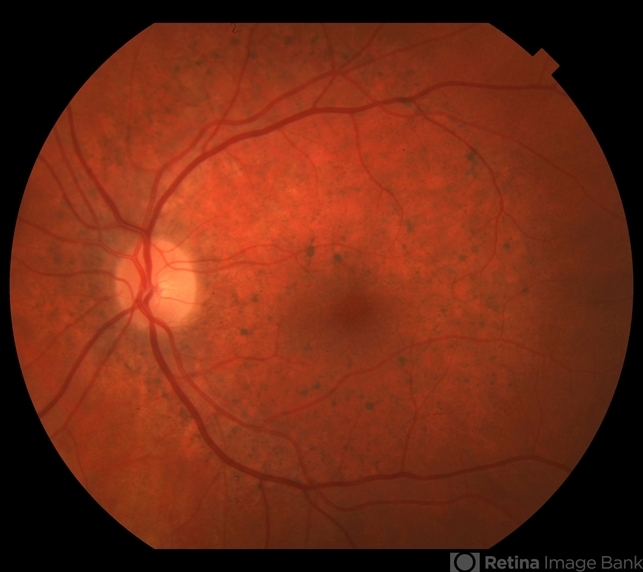 Pentosan Polysulfate Maculopathy