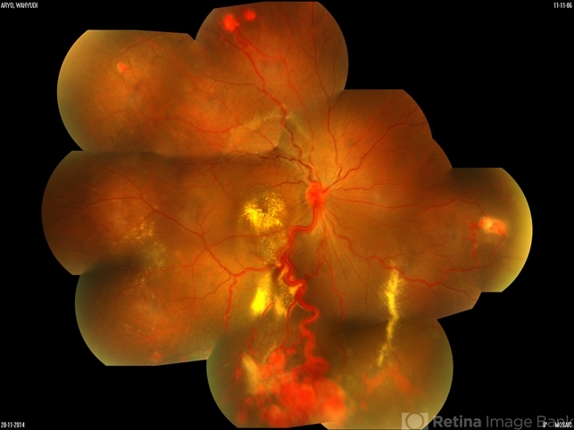 Von Hippel-Lindau Syndrome