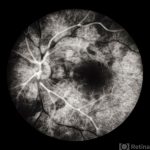 Central Serous Chorioretinopathy